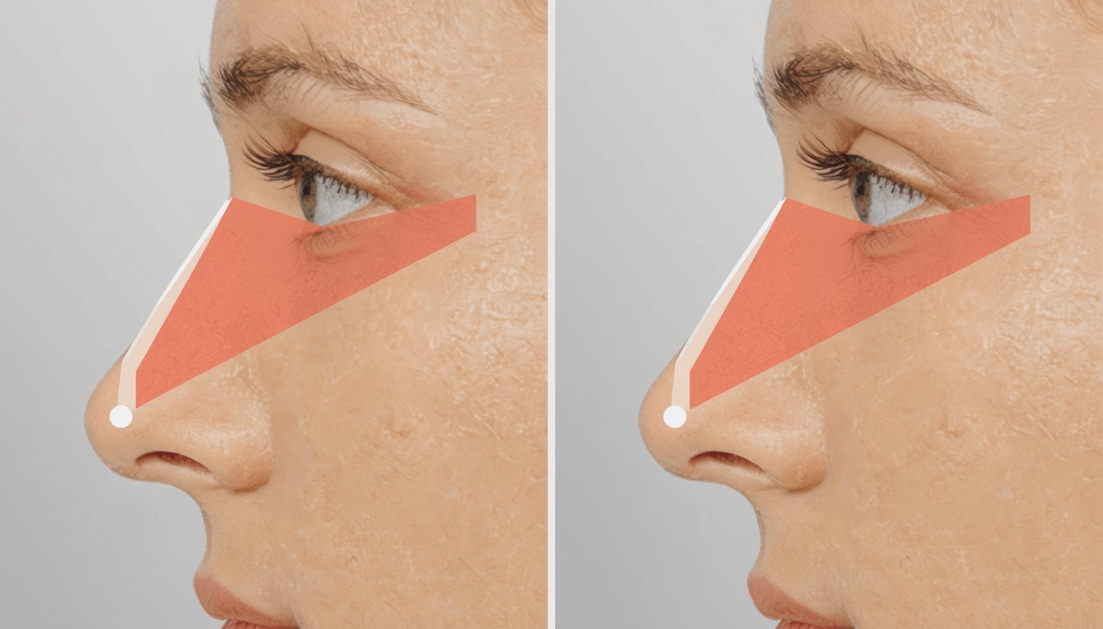 Revision Rhinoplasty Abroad: What No One Tells You Before You Search